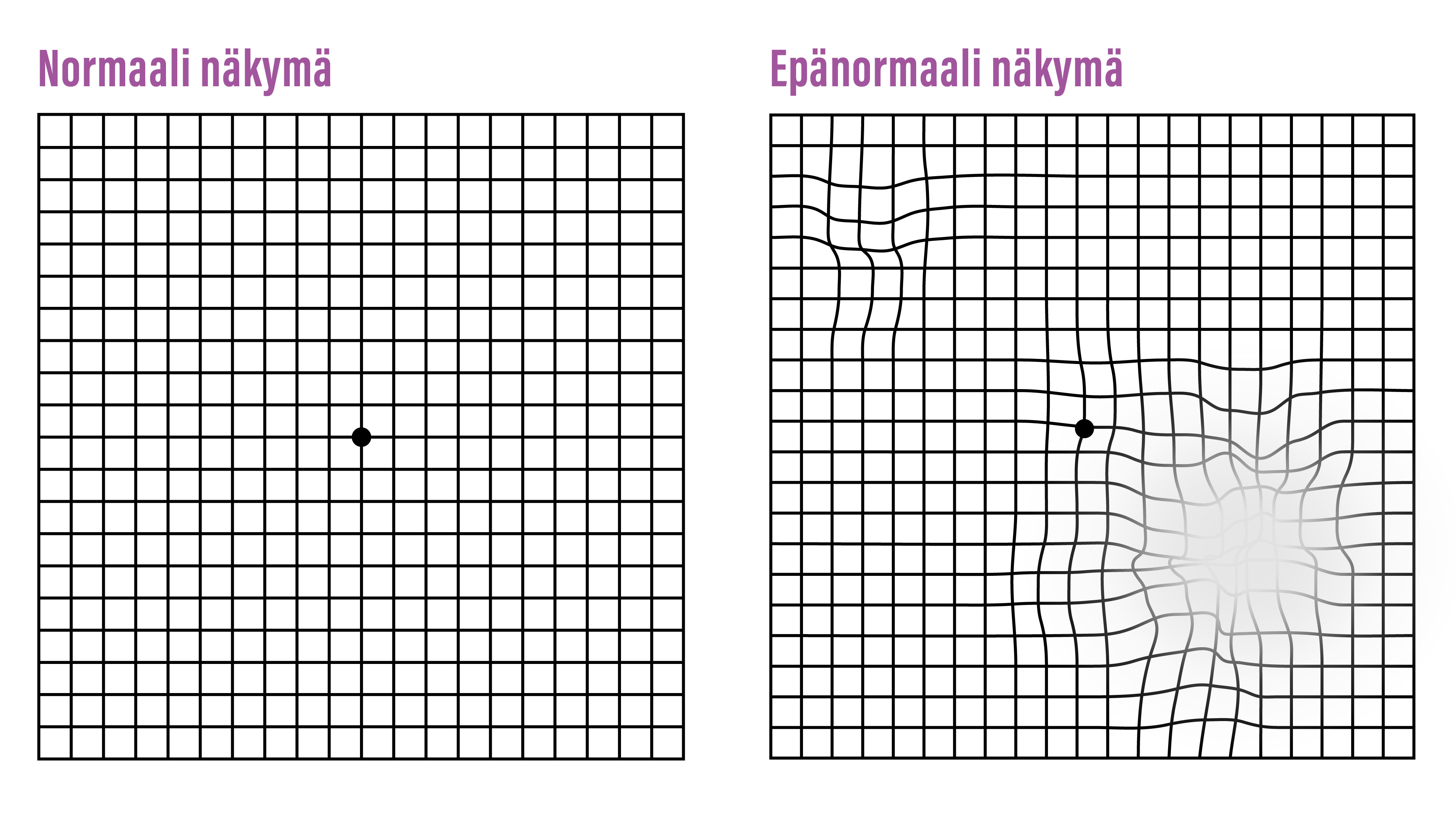 Amslerin kartta joka kuvaa normaalia ja epänormaalia näkymää