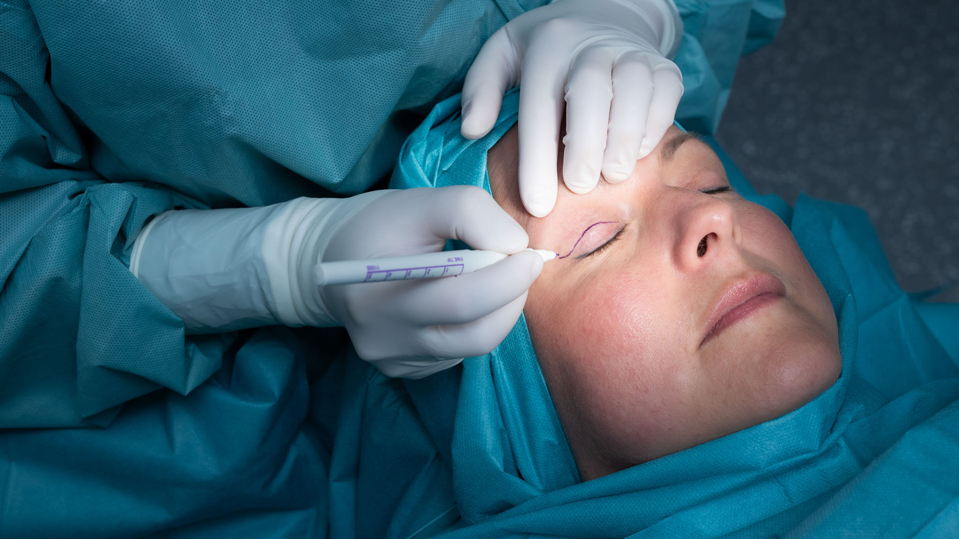 Potilas silmäluomileikkauksessa, kirurgi valmistelee piirtämällä luomeen